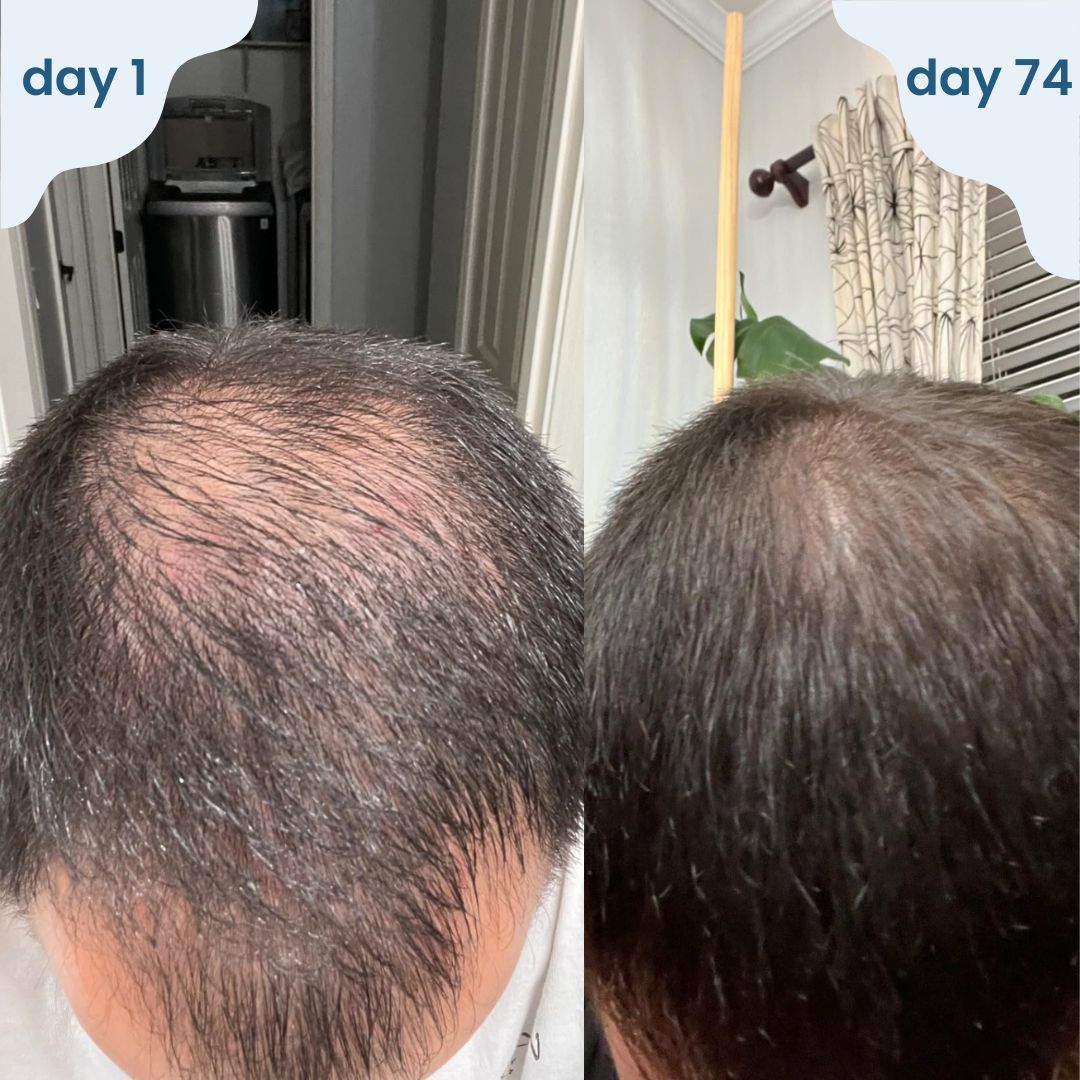 Bloomy - hair regrowth stick