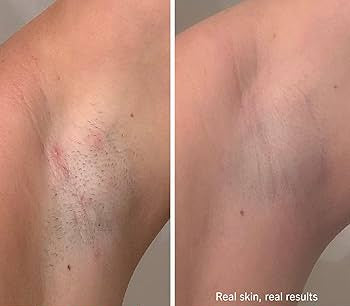 Real customer razor bump transformation