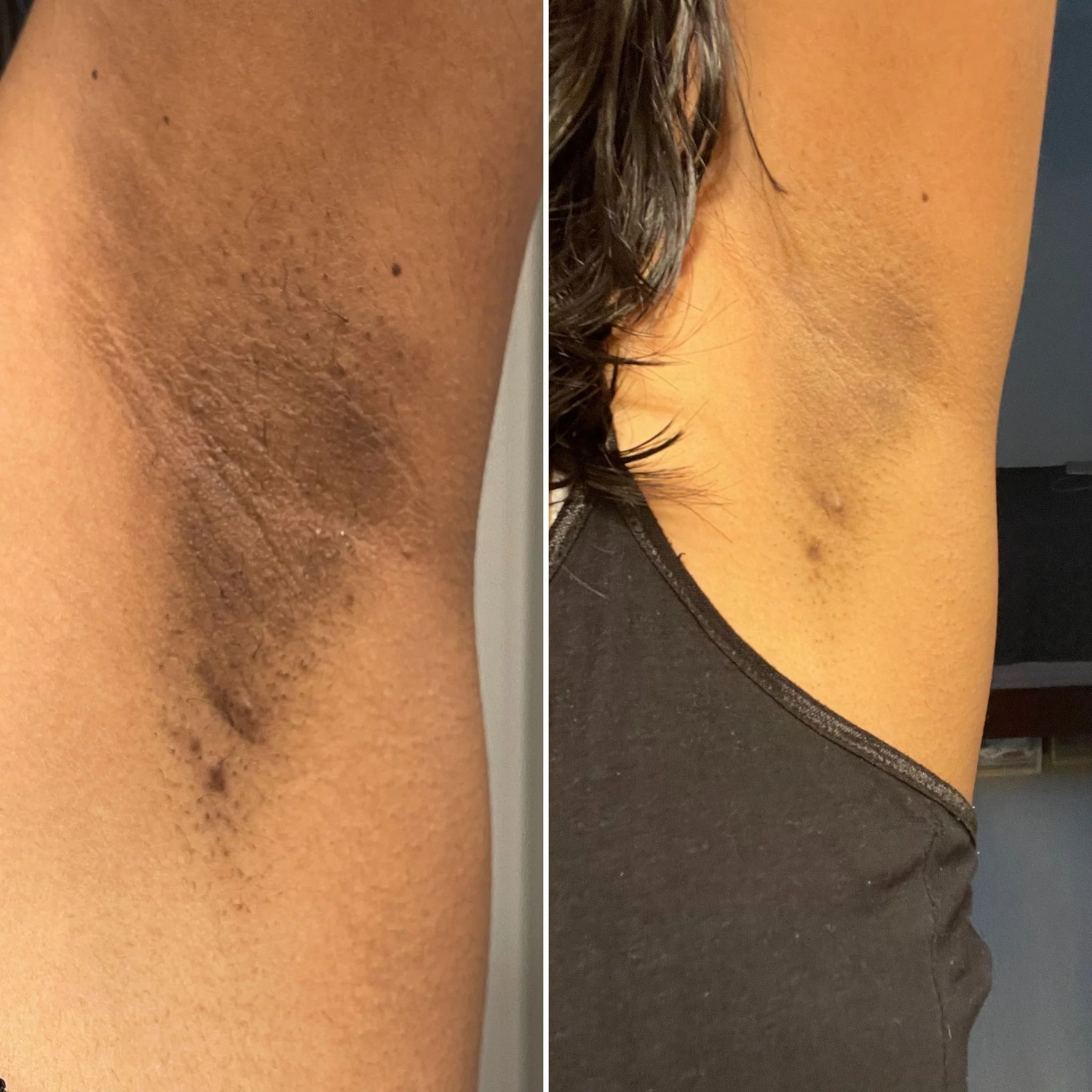 Dark patches before and after